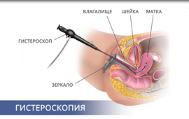 Гістероскопія в Медікум